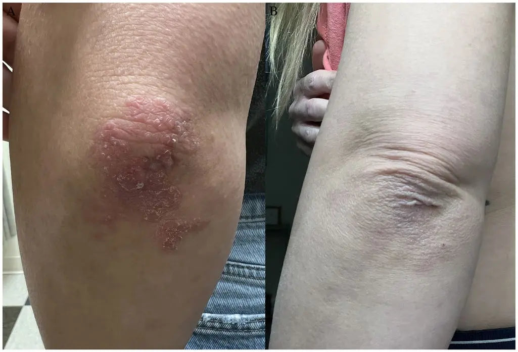 Before and after images from a 12-week Wake Forest Dermatology study participant showing improvement in psoriasis symptoms.