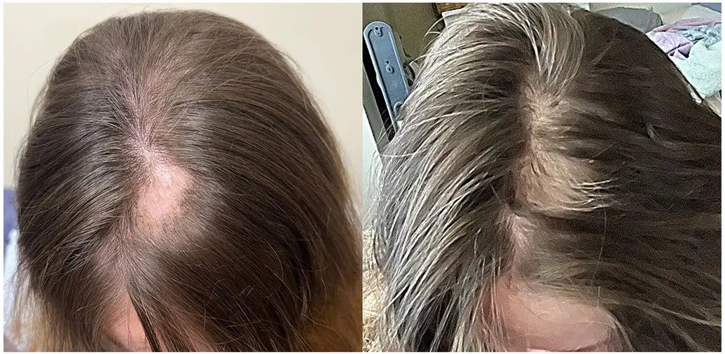 Before and after images from a 12-week Wake Forest Dermatology study participant showing improved hair coverage.